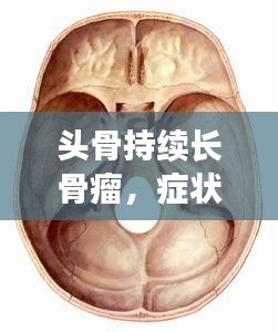头骨持续长骨瘤，症状、成因与治疗方案深度解析