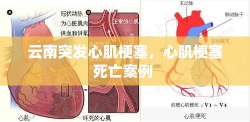 云南突发心肌梗塞，心肌梗塞死亡案例 