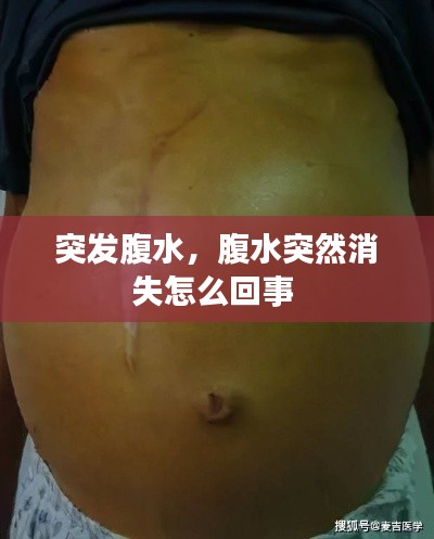 突发腹水，腹水突然消失怎么回事 