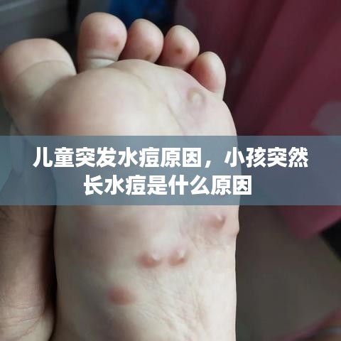 儿童突发水痘原因，小孩突然长水痘是什么原因 