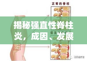 揭秘强直性脊柱炎，成因、发展与突发性的真相解析