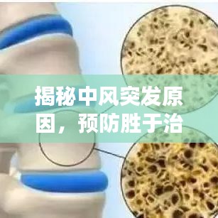 揭秘中风突发原因，预防胜于治疗！