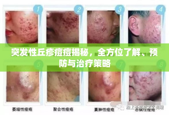 突发性丘疹痘痘揭秘，全方位了解、预防与治疗策略