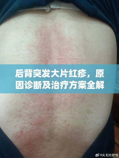 后背突发大片红疹，原因诊断及治疗方案全解析